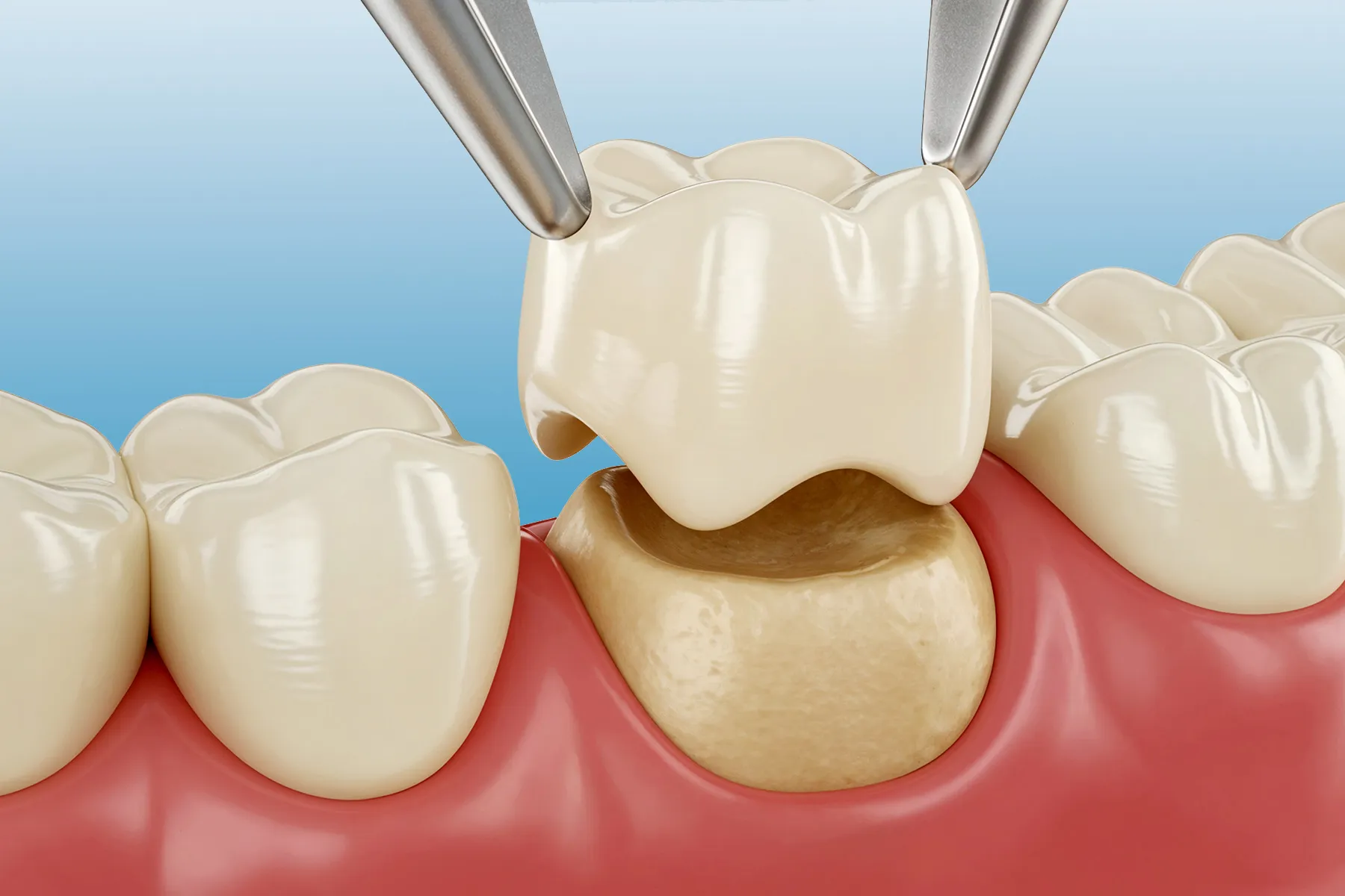 Zircon Crowns