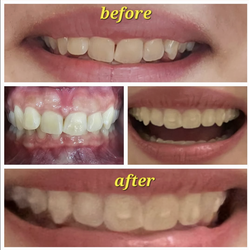Hollywood Smile