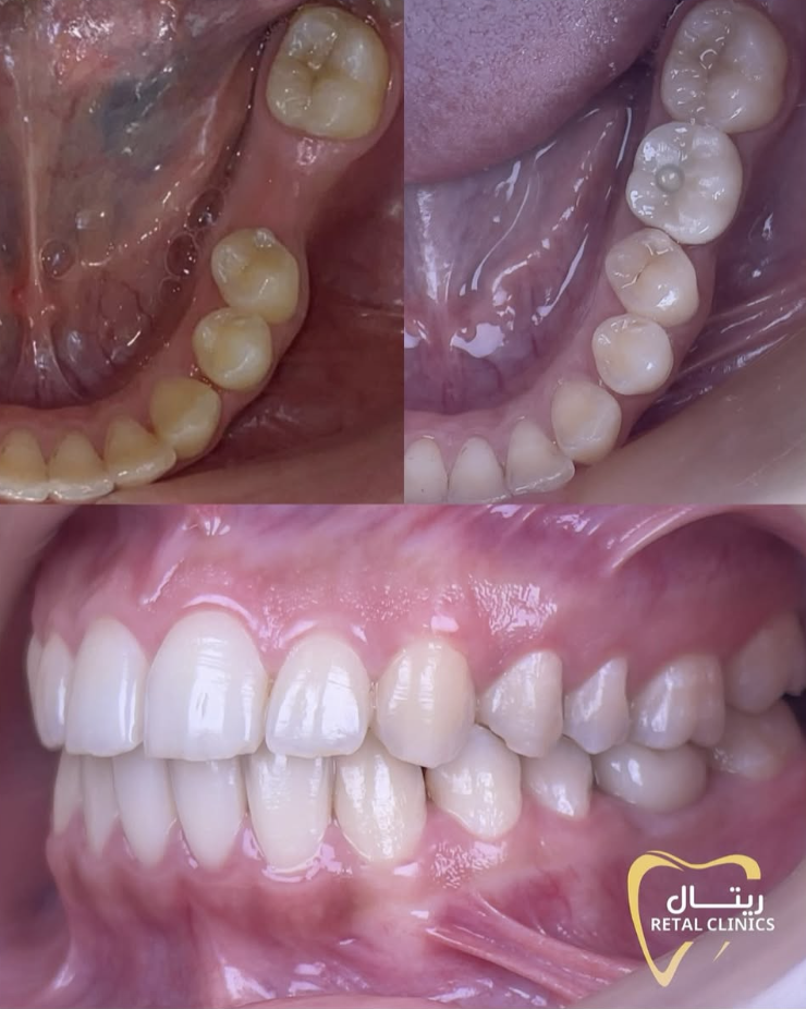 Dental Implants