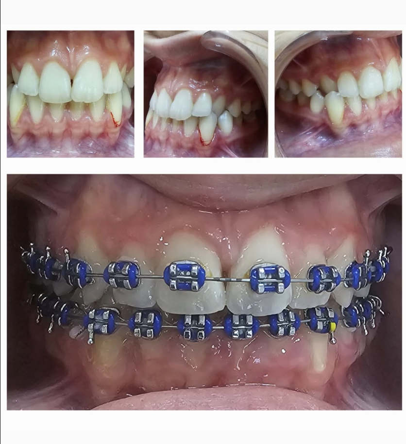 Orthodontics (Braces)