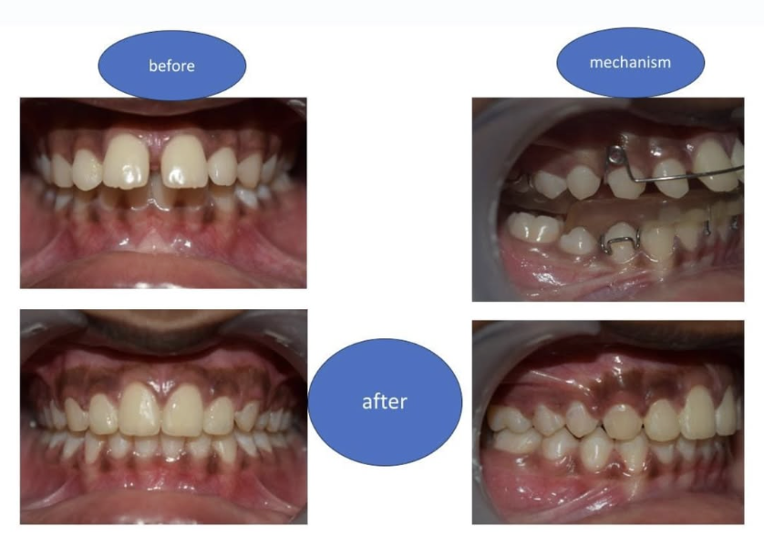 Porcelain Veneers