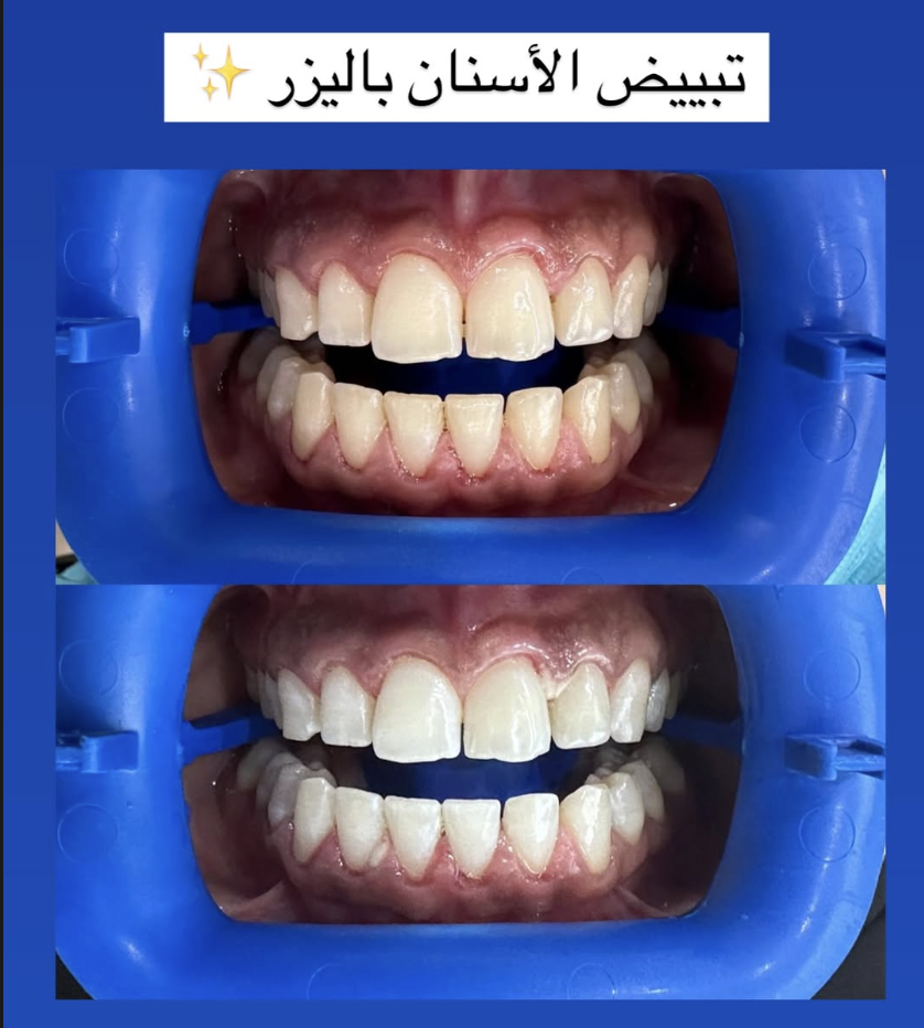 Teeth Whitening
